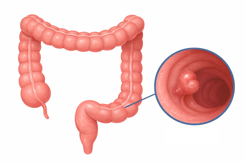 colon polyp